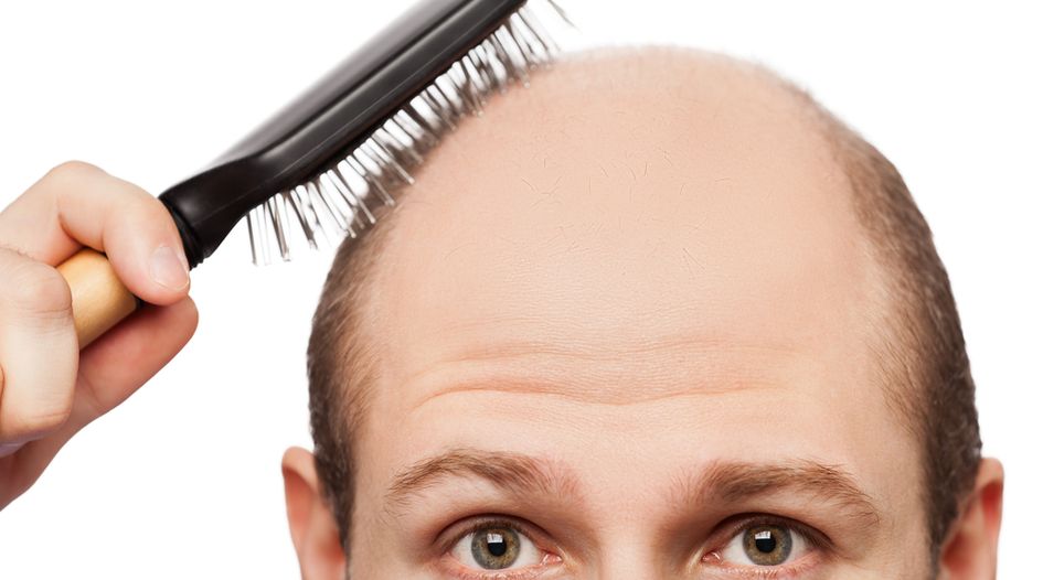 Japanese group faces claim over alopecia therapy